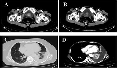 Lung adenocarcinoma with bladder metastasis: A case report and literature review